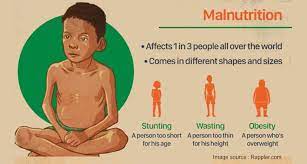 Guide on Malnutrition, Causes, Symptoms, Types And Side Effects.