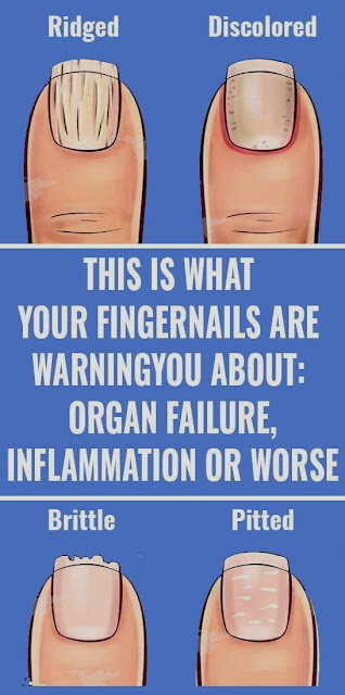 This Is What Your Fingernails Are Warning You About: Organ Failure, Inflammation, or Worse