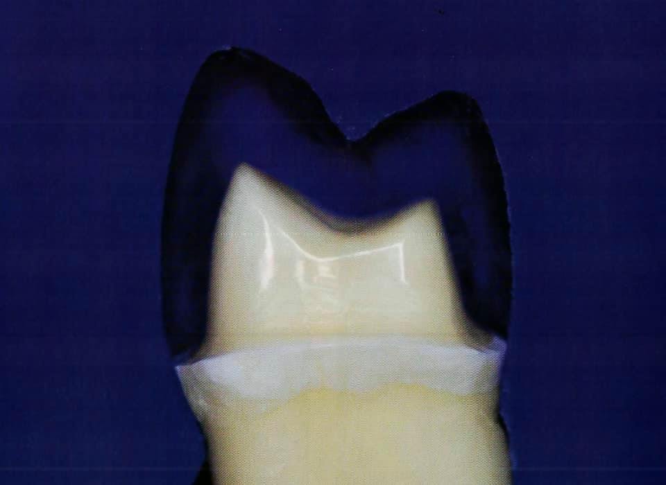 Posterior crown preparation Dental Esthetics