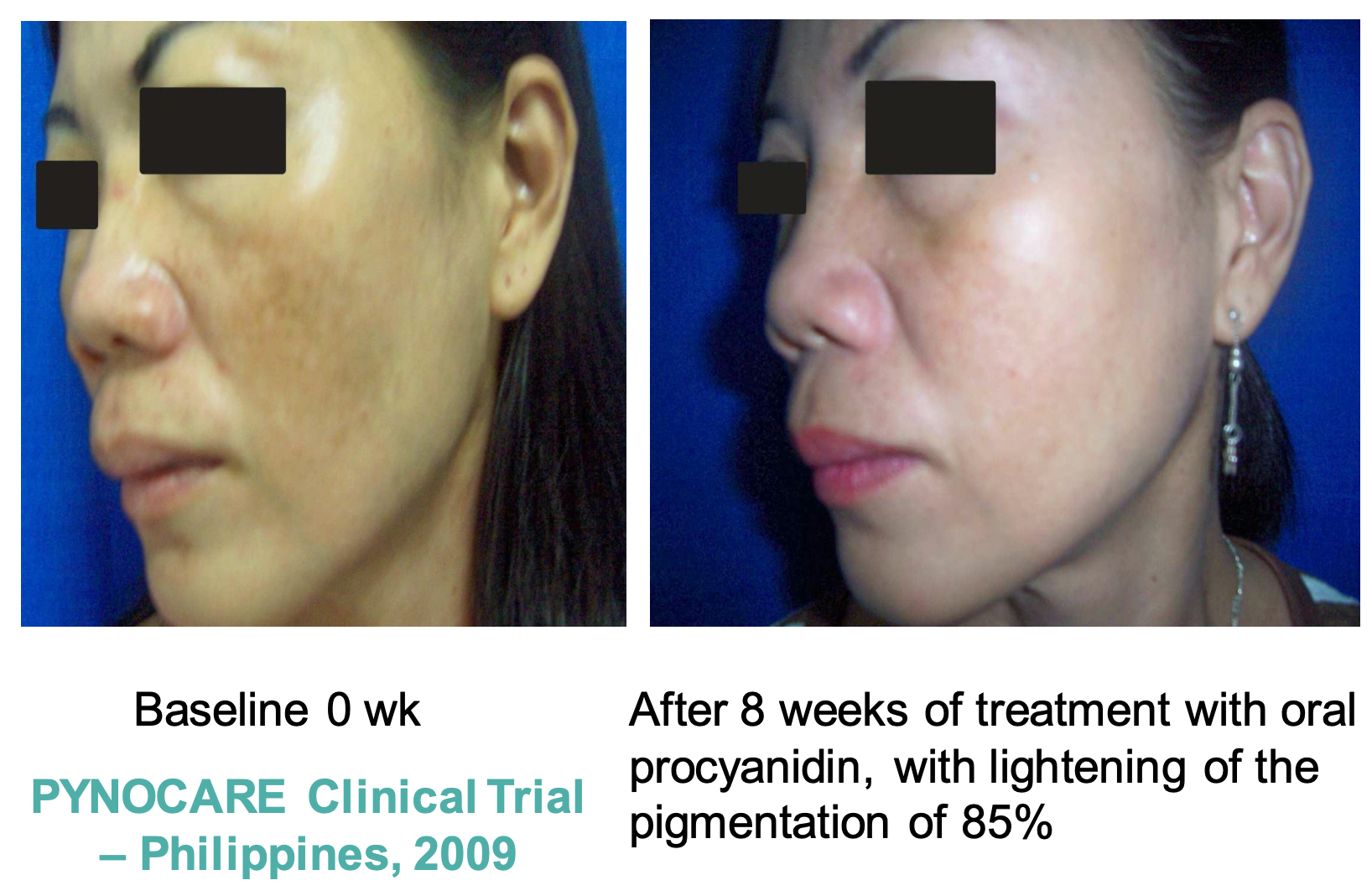 WHAT CAUSES MELASMA? Treatments, Types, Prevention