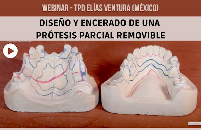 WEBINAR: Diseño y Encerado de una Prótesis Parcial Removible - TPD ...