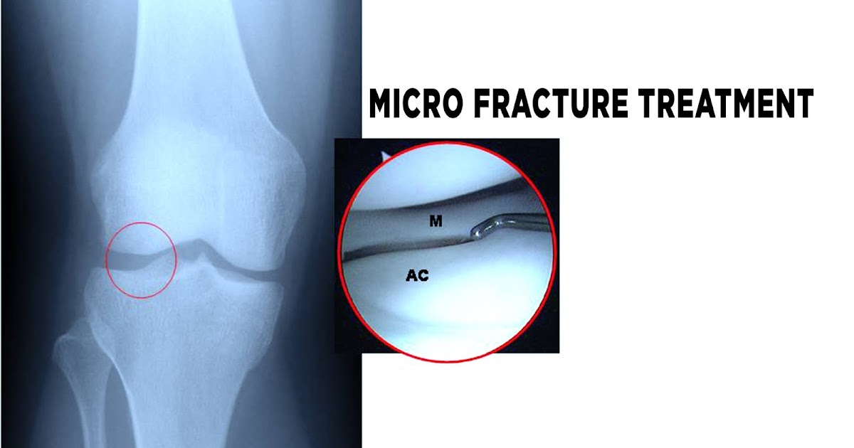 Micro Fracture Treatment Micro Bone Fracture Surgery