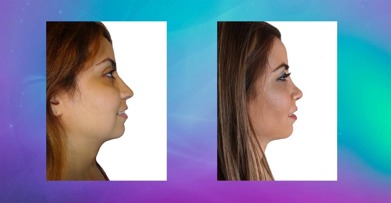 Xxx Karina Image - Gran cambio de Karina con la operaciÃ³n de su nariz - CirugÃ­a PlÃ¡stica  MartÃ­nez