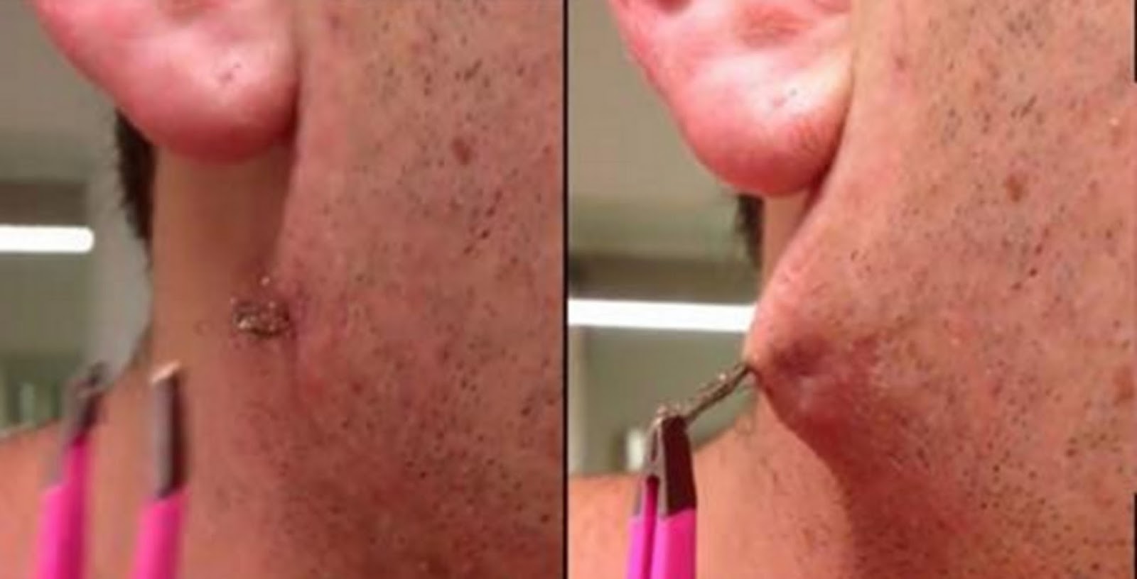WATCH Man Pulls Out The Worlds Longest Ingrown Hair From