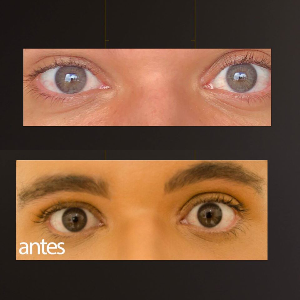 Laser Surgery Helps to Change Eye Color Permanently