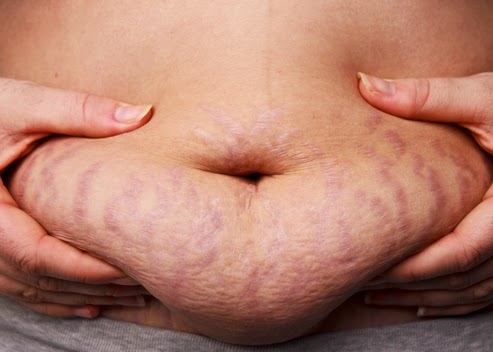 The Ugliness of Stretch Marks!