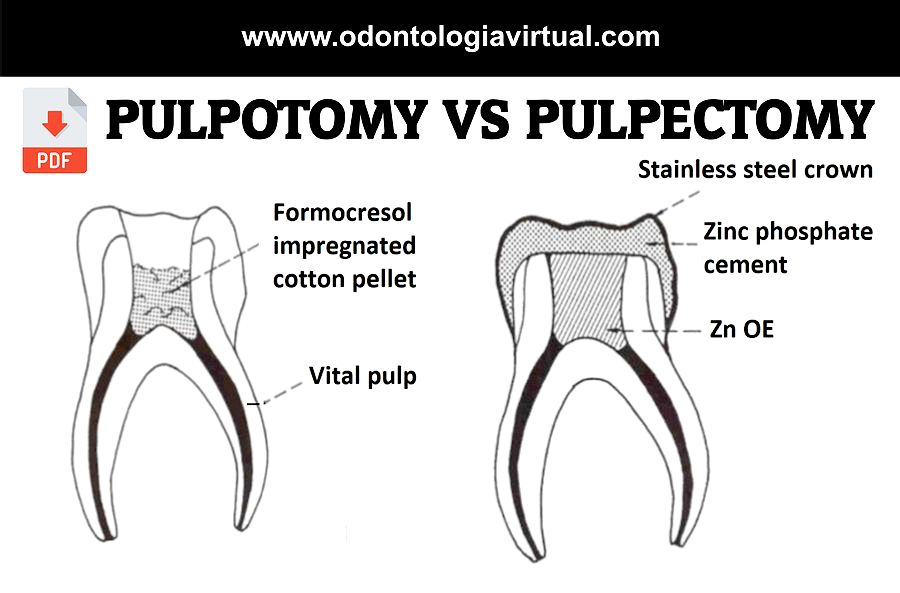 PDF Pulpotomy versus pulpectomy in the treatment of vital pulp