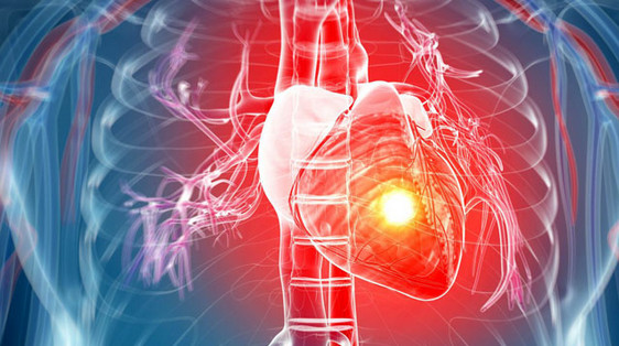 Learn what a heart attack is and what to do to prevent it