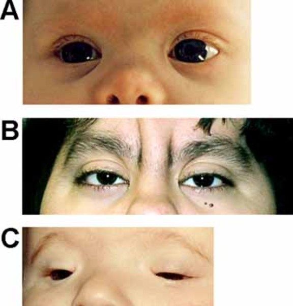 3p deletion syndrome: Genetics Home Reference