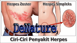 gambar Penyakit Herpes zoster dan Simpleks