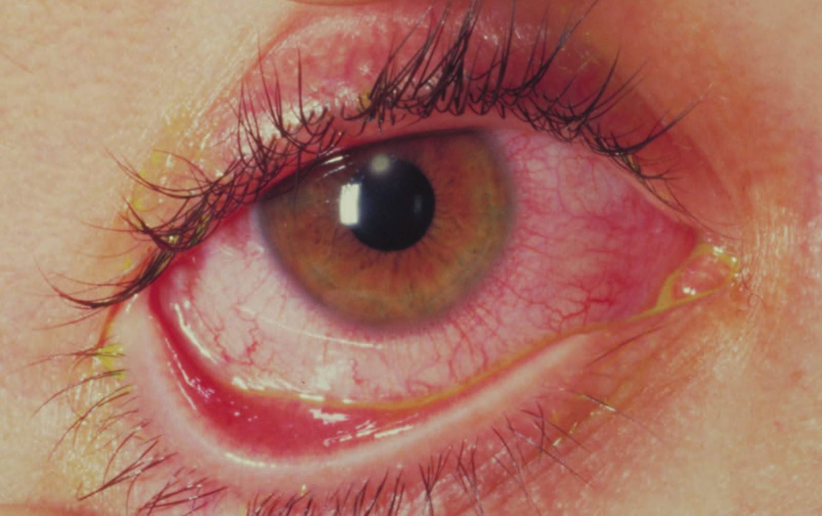 study medical photos corneal ulcer clinical features and management corneal ulcer