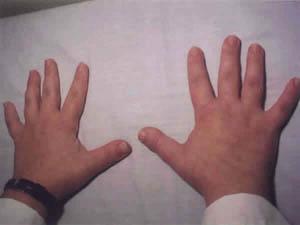 La biología inteligente Braquidactilia