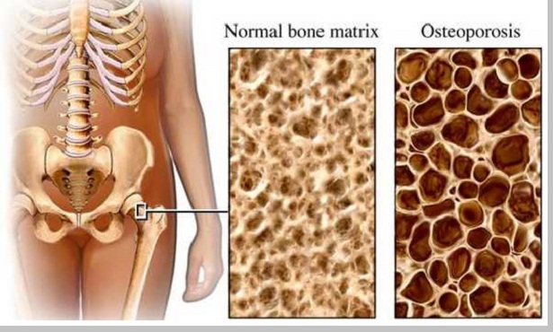 Osteoporosis (penyakit kekurangan kalsium pada tulang)