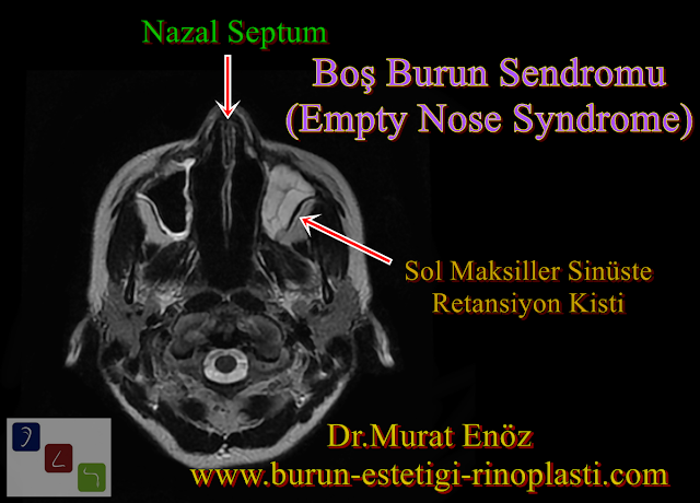 Burun Eti Ameliyatı