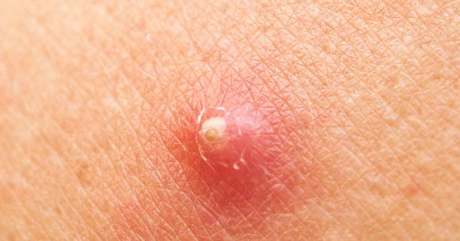 Cara Paling Ampuh Mengatasi Bisul Dengan Menggunakan Bahan Alami
