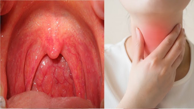Pharyngitis : Symptoms and Causes ! What is Pharyngitis