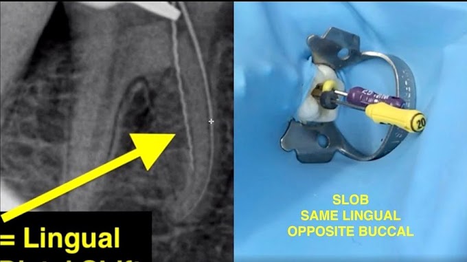 ENDODONTICS: How to determine root canal working lengths with X-rays