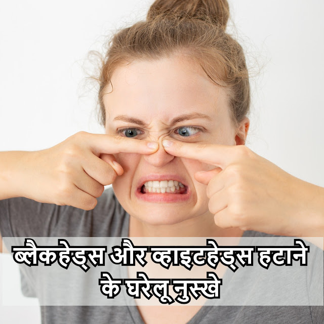 Blackheads और Whiteheads हटाने के घरेलू नुस्खे