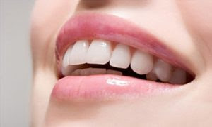 Niềng răng khấp khểnh mất thời gian bao lâu?