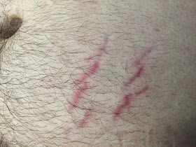 Bartonella How Prevalent Is Bartonella In People Who Have Lyme