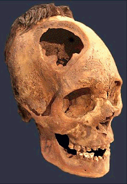 Imagen Trepanación Craneana