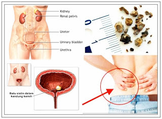 Obat Batu Ginjal Atau Kencing Batu Agar Cepat Sembuh 