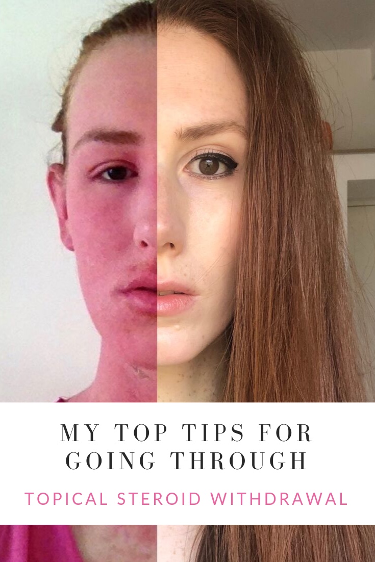 My top tips for going through Topical Steroid Withdrawal TSW Cara