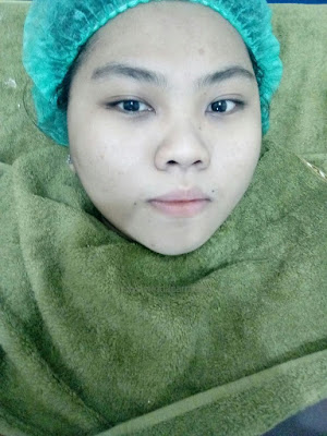 karadenta, karadenta clinic, karadenta malang, karadenta surabaya, karadenta jogja, karadenta bandung, karadenta samarinda, flek, jerawat, menghilangkan jerawat, terapi jerawat, laser, sinar laser, whitening, kerutan, penuaan dini, perawatan wajah di malang, facial, facial di rumah,