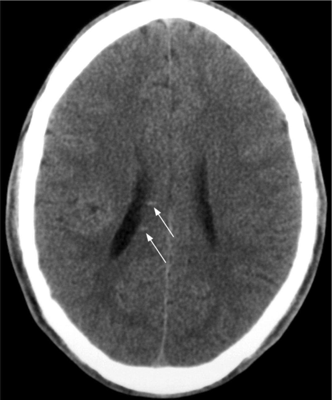 Medical Legal Demonstrative Evidence Axonal Shearing