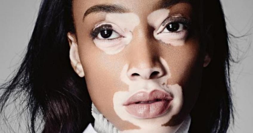 Hair Loss Arena: Eliminate VITILIGO! Guaranteed Proven Method.