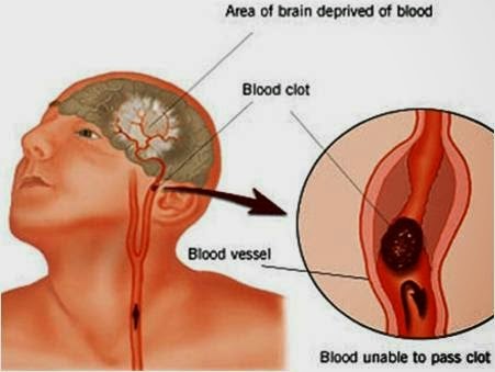Vascular Dementia Early Warning Signs Causes Diagnosis And