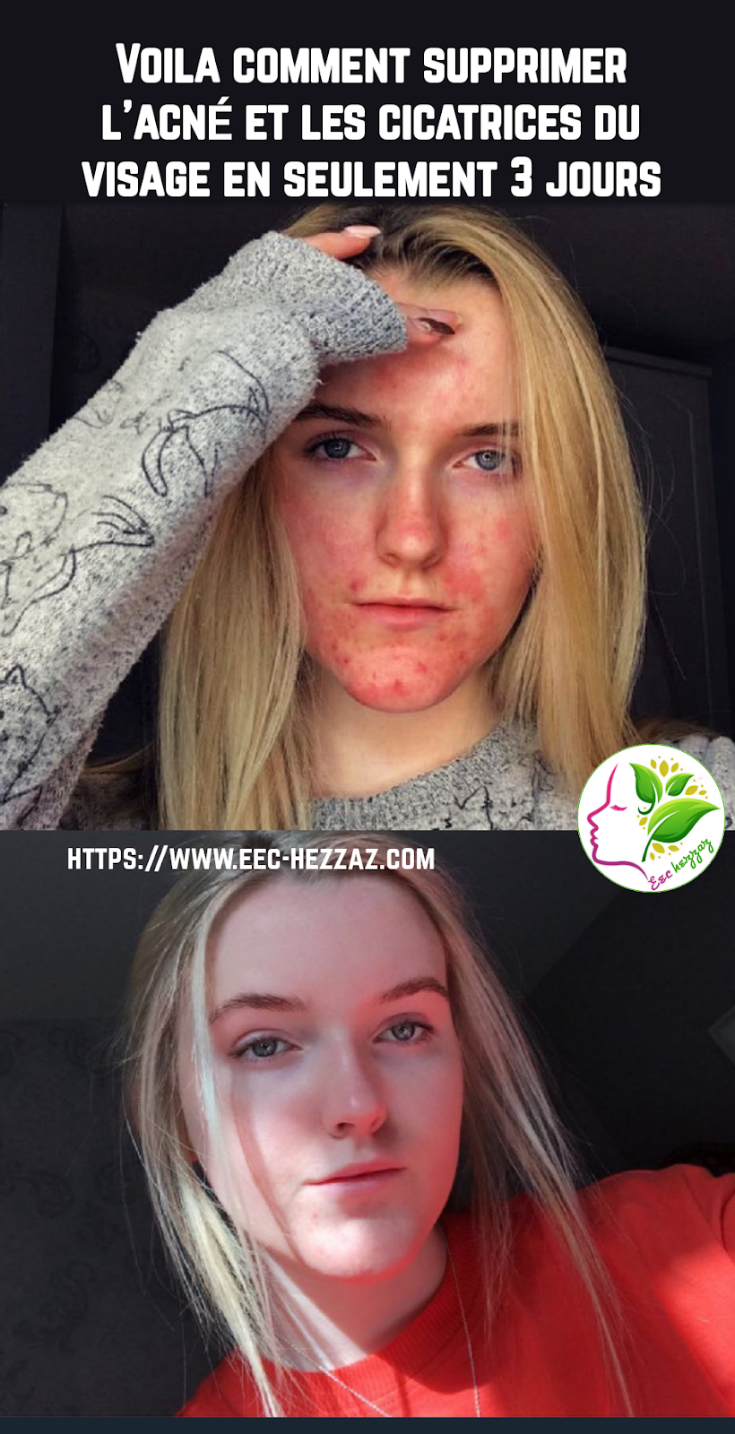 Voila comment supprimer l'acné et les cicatrices du visage en seulement 3 jours