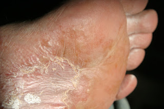 Cara Alami Mengatasi Eksim Di Telapak Kaki Cara Alami Mengatasi Eksim Di Telapak Kaki