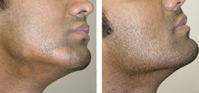 alopecia aureata barba