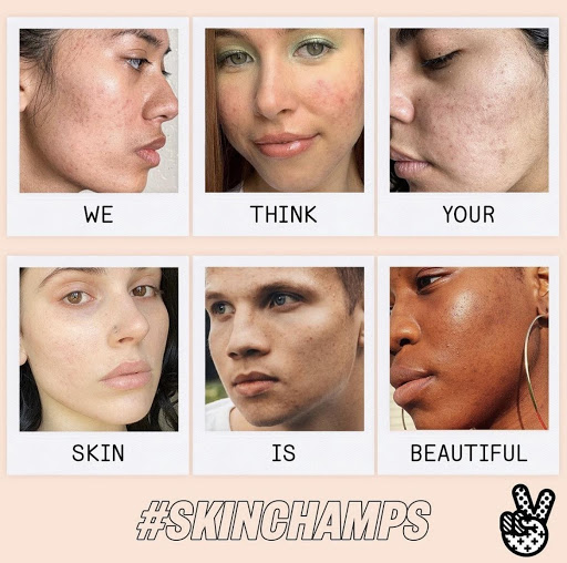 "Acne, Unfiltered" The Peace Out Skincare Campaign (Source: Shortyawards Blog)