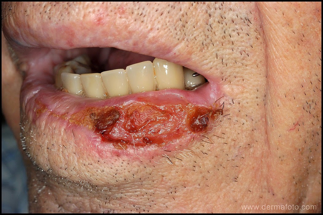 Atlas virtual de histologia e patologia: [CC #3]: CARCINOMA ESCAMOCELULAR