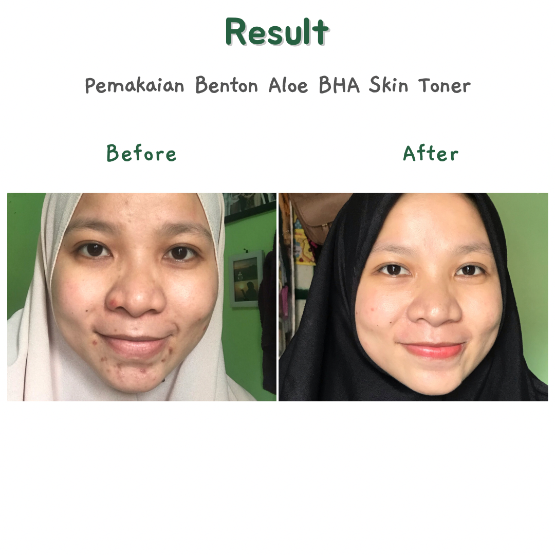 Review Benton Aloe BHA Skin Toner, Exfoliating Toner Yang Aman Untuk