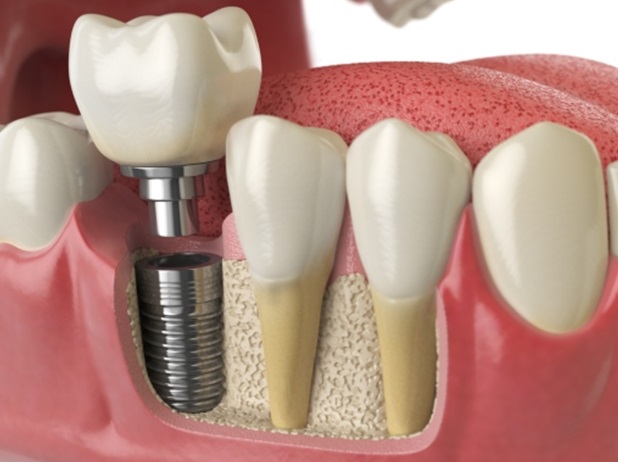Cosmetic Dentistry with Dental Implants