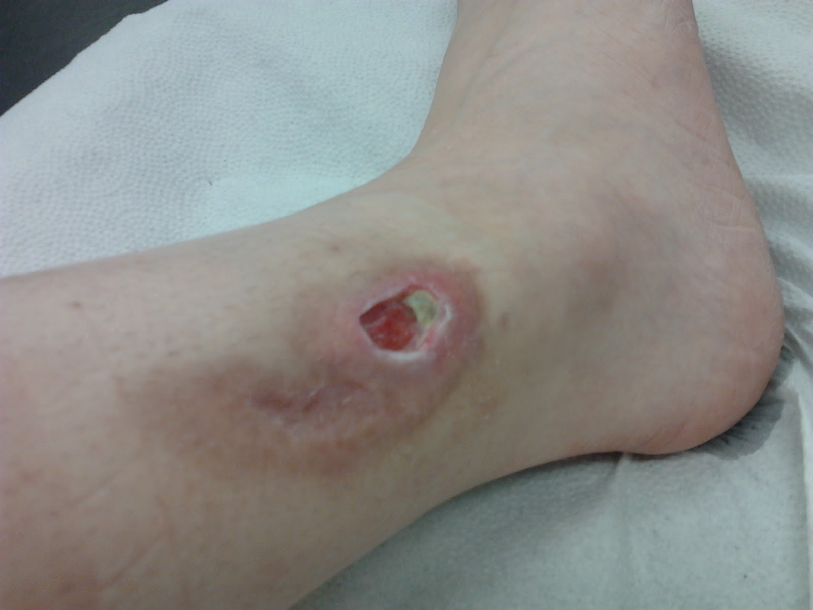 Leg ulcer images, picture of venous and arterial leg ulcers