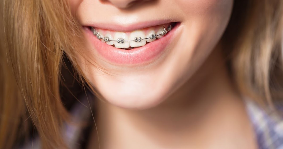 DIY Dental Impression Kit The Clearing Braces Cincinnati