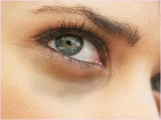علاج الهالات السوداء حول العينين