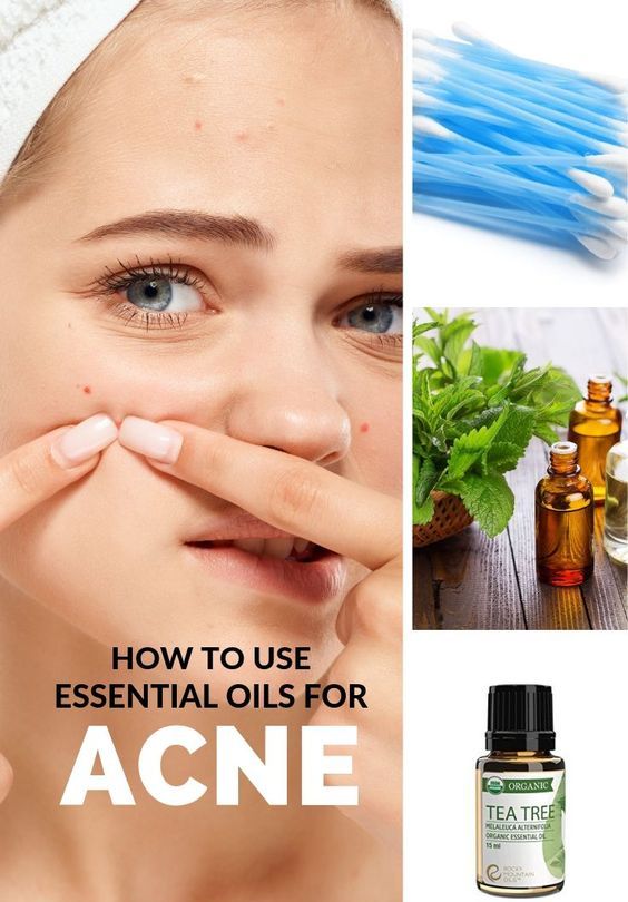 Top 5 Best Essential Oils for Acne, Pimples, Blackheads & Blemishes