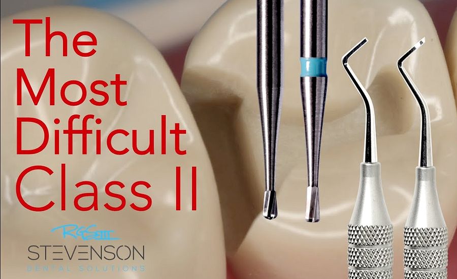 COMPOSITE RESTORATION The Most Challenging Class II Richard G. Stevenson