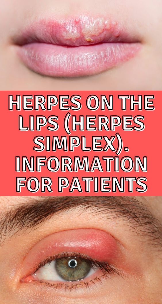 Herpes on the lips (herpes simplex). Information for patients Healthy