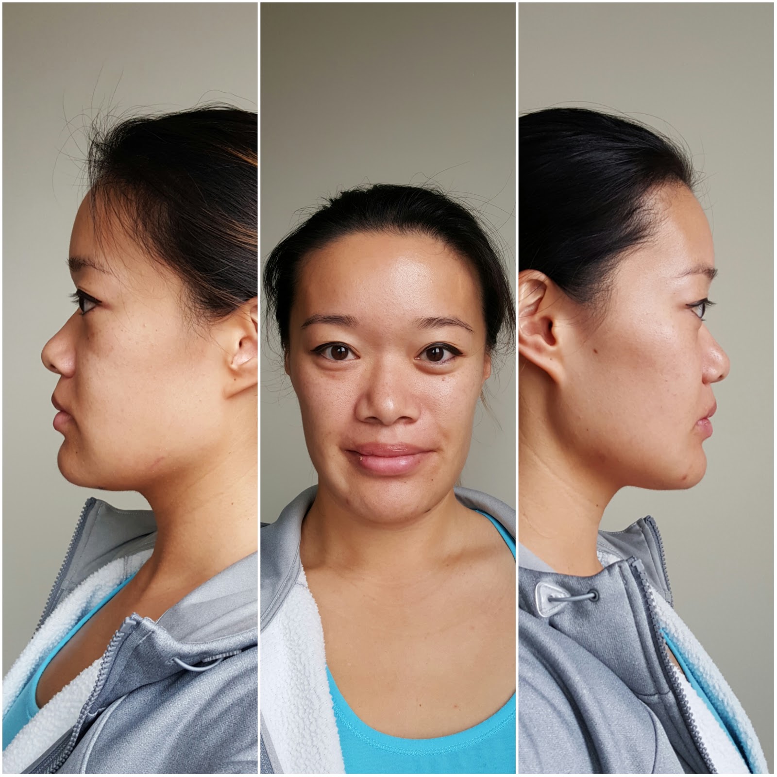 Tina's Double Jaw Surgery Day 20 More Friendly Visits