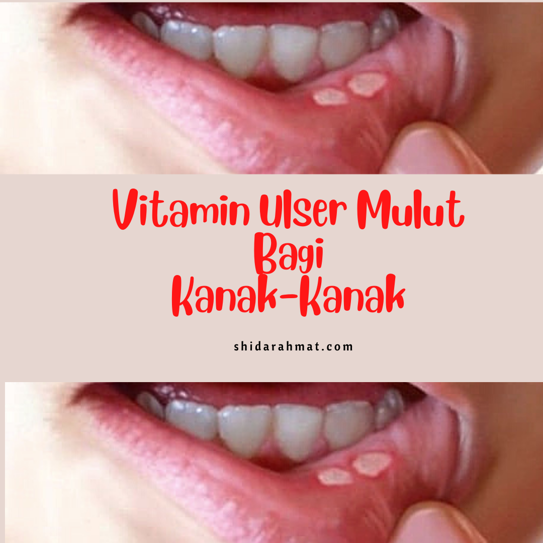 Mulut kanak kanak ulser Tip untuk