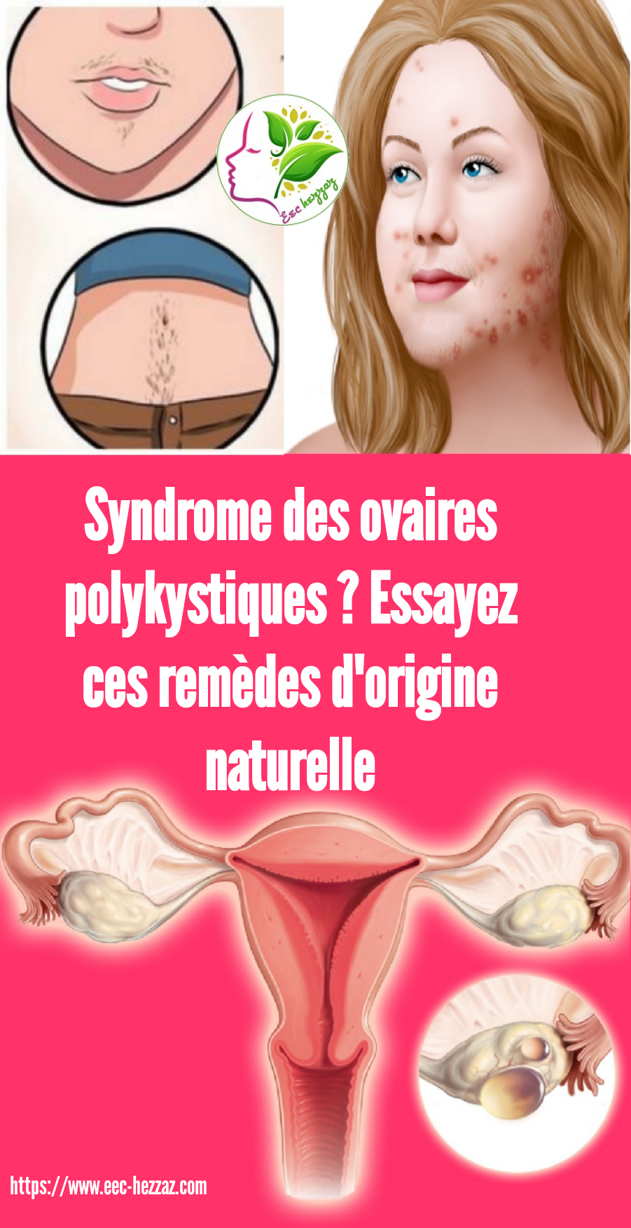 Syndrome des ovaires polykystiques ? Essayez ces remèdes d'origine naturelle
