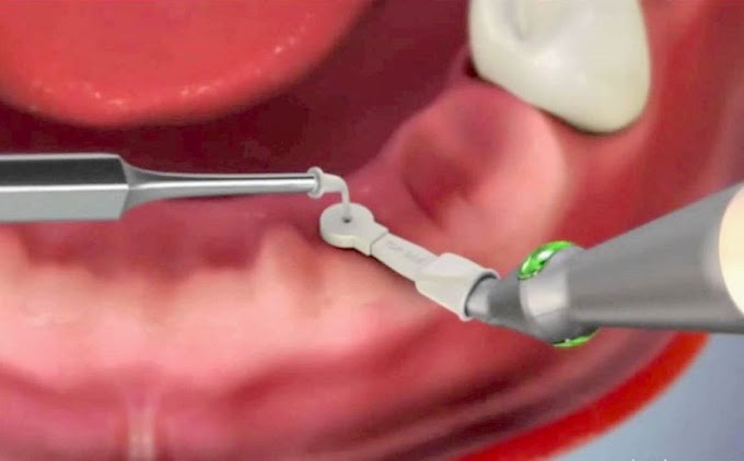 POINTER: Detector de Implantes Dentales