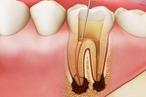 Caries cause death of the pulp, serious consequences