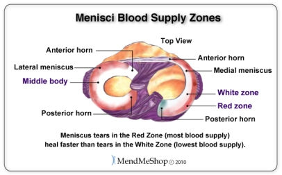 leziune grad 2 corn posterior menisc intern